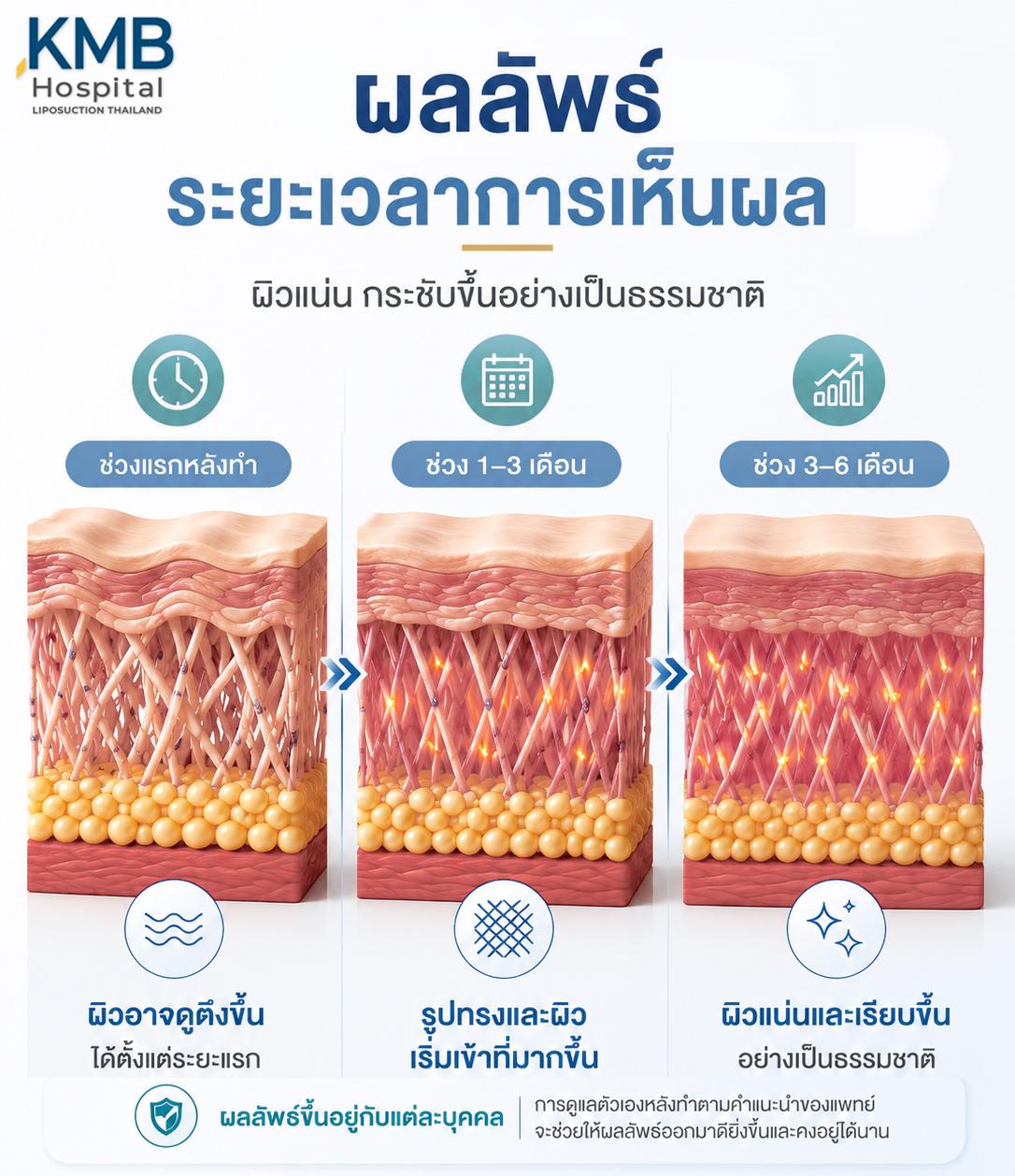 ภาพแสดงระยะเวลาการเห็นผลหลังทำ J-Plasma ผิวกระชับขึ้นตามลำดับ 0-6 เดือน